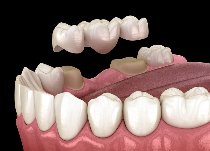 Dental Bridges in Littleton, CO