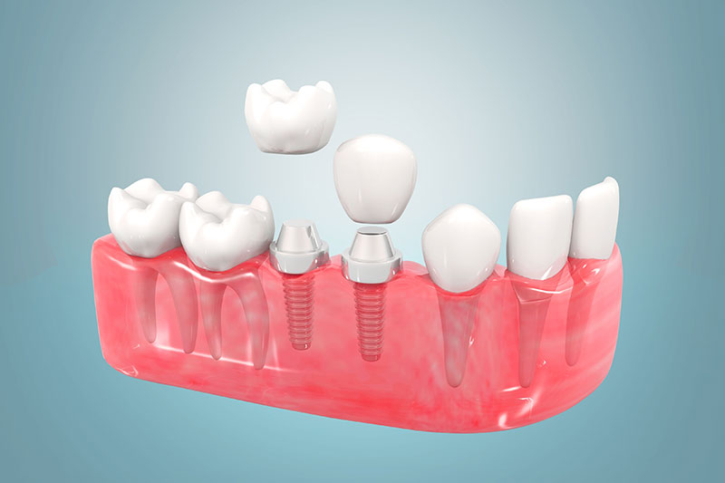 dental implants in littleton, CO