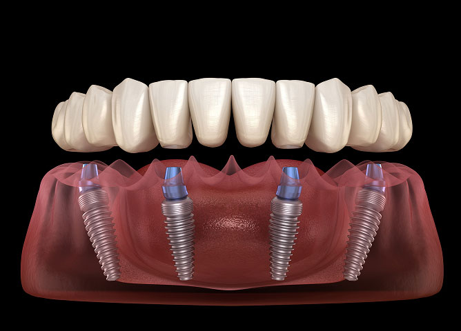 all on x implants