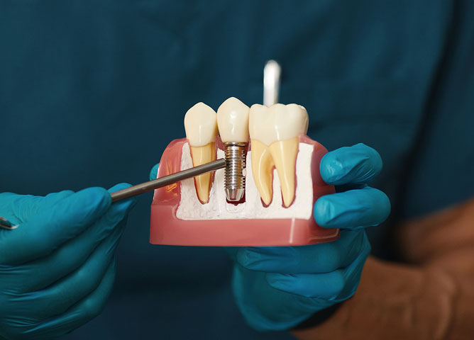 dental implants near you