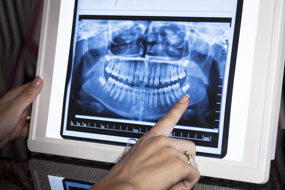 X-ray image of dental structure with a hand pointing, highlighting the importance of dental screenings for seniors to detect issues like oral cancer.