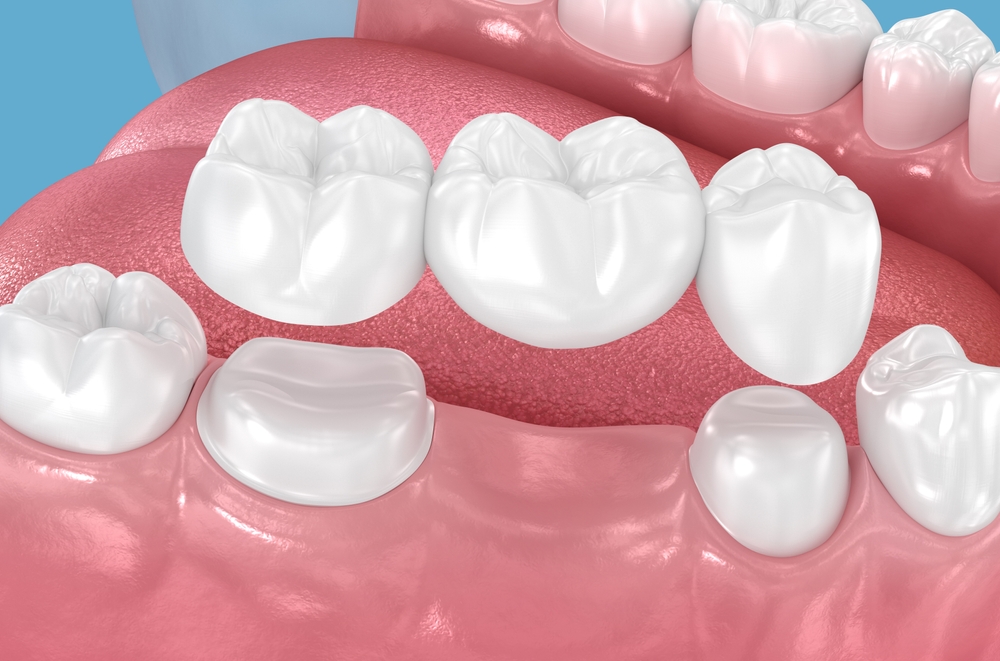 dental bridges in Littleton, CO